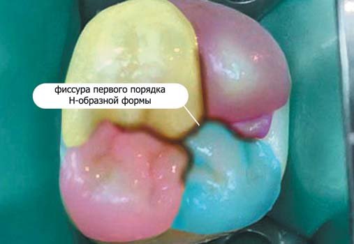 Крок моделювання коронкової частини першого моляра верхньої щелепи