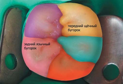 Крок моделювання коронкової частини першого моляра нижньої щелепи