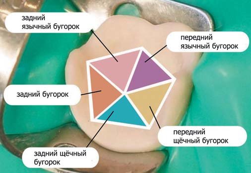 Крок моделювання коронкової частини першого моляра нижньої щелепи