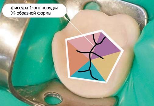 Крок моделювання коронкової частини першого моляра нижньої щелепи