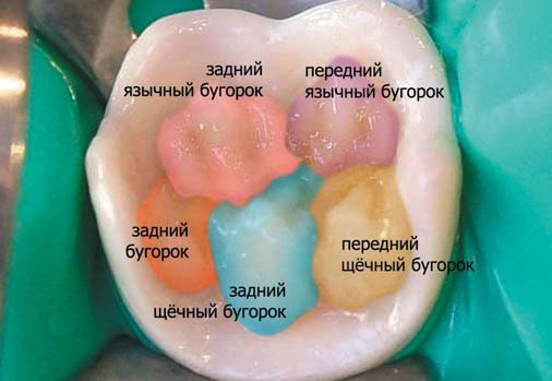 Крок моделювання коронкової частини першого моляра нижньої щелепи