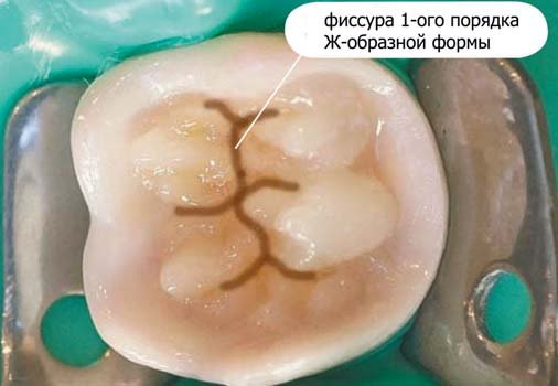 Крок моделювання коронкової частини першого моляра нижньої щелепи