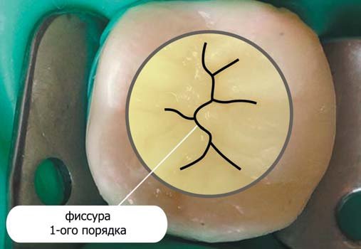 Крок моделювання коронкової частини першого моляра нижньої щелепи