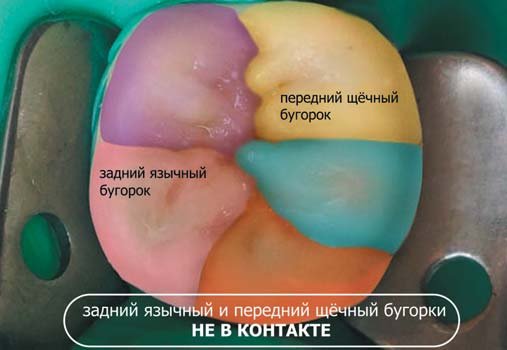 Крок моделювання коронкової частини першого моляра нижньої щелепи