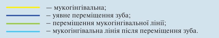 Умовні позначення: мукогінгівальна; уявне переміщення зуба; переміщення мукогінгівальної лінії; мукогінгівальна лінія після переміщення зуба
