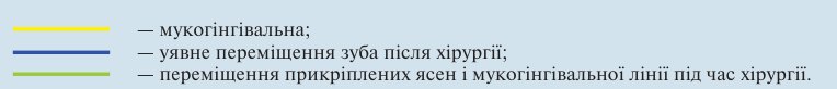 Умовні позначення: мукогінгівальна; уявне переміщення зуба після хірургії; переміщення прикріплених ясен і мукогінгівальної лінії під час хірургії