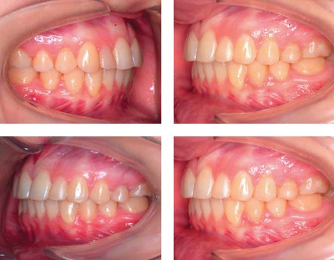 Бічні фотографії ліворуч, до і після окклюзійного протоколу засвідчують можливість використання його локально, без тотальної реабілітації зубного ряду.