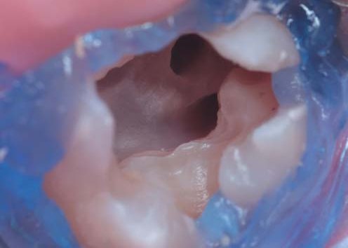 Дистально-піднебінний канал.