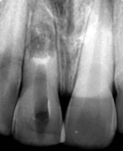 Фото 9. Рентгенологічний контроль пакування Biodentine.