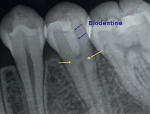 Рентгенограма: видно формування дентинного містка (Biodentine).