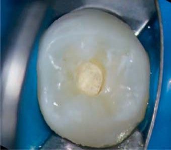 Biodentine нанесено на пульпу.