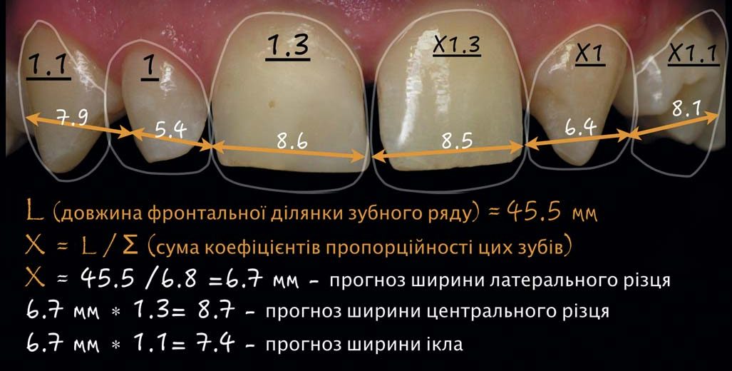 Планування реконструкції лінії усмішки: фотографії шліфів зубів, схема розрахунку зубного ряду з елементами DSD та початкова клінічна ситуація