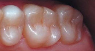 Лівий сектор: покроковий фотопротокол реставрації бічних зубів верхньої щелепи