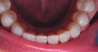 Нижні передні зуби: оклюзійний і латеральні види