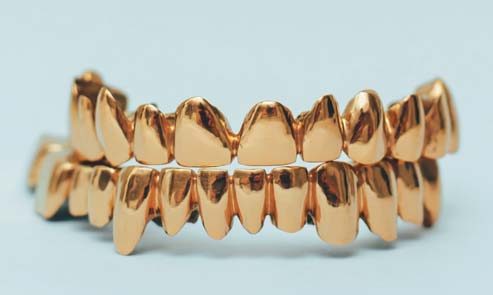Золоті коронки на верхньому і нижньому зубних рядах
