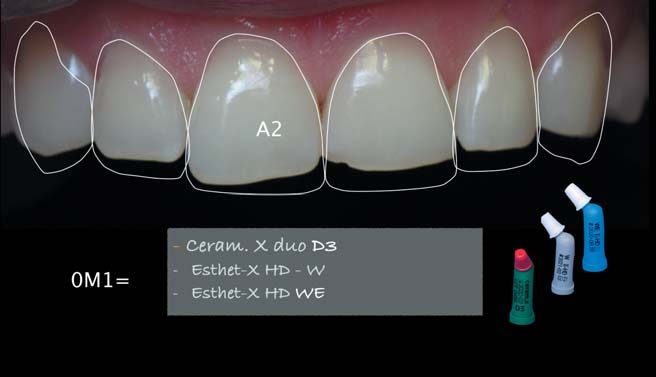 Колірний рецепт 0М1: Ceram. X duo D3, Esthet-X HD W, Esthet-X HD WE