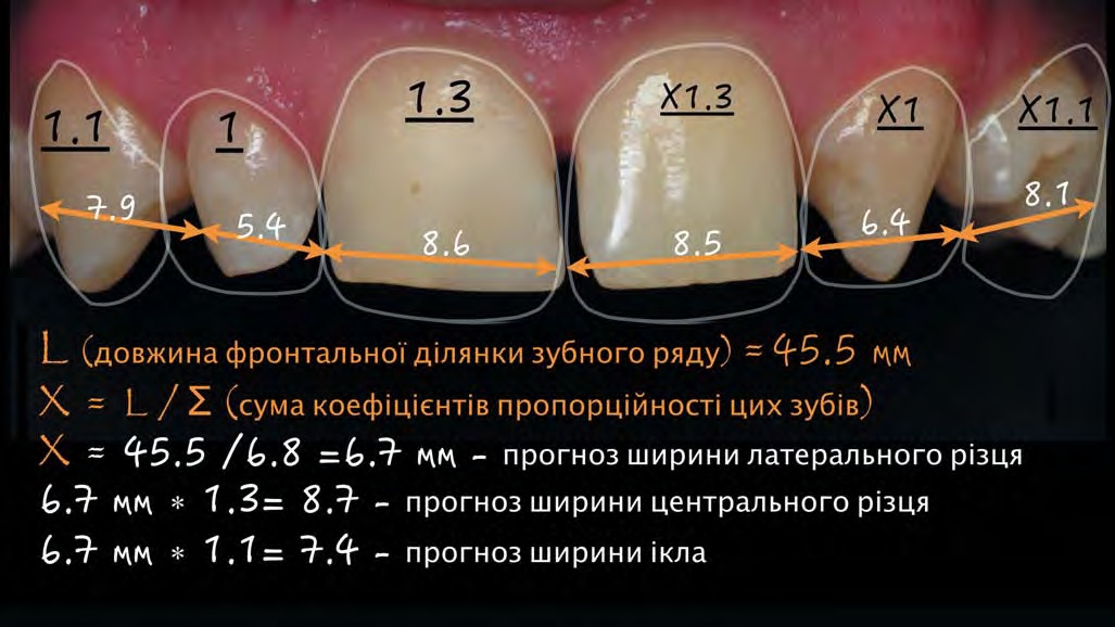 Схема розрахунку зубного ряду з елементами DSD
