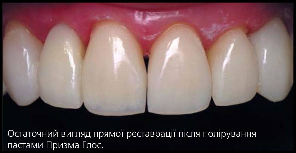 Остаточний вигляд прямої реставрації