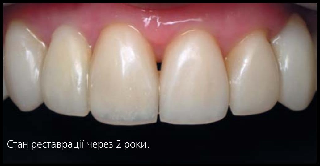 Стан реставрації через 2 роки