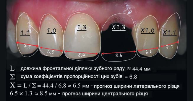 Схема розрахунку зубного ряду з елементами DSD