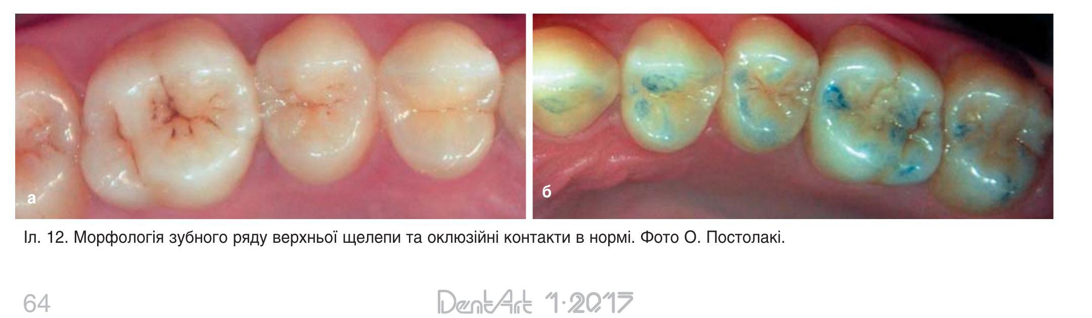Морфологія зубного ряду верхньої щелепи та оклюзійні контакти в нормі