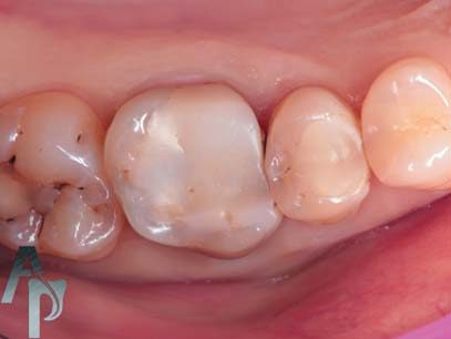 Вигляд зубів на момент звернення (реферативна пацієнтка, 34 роки).