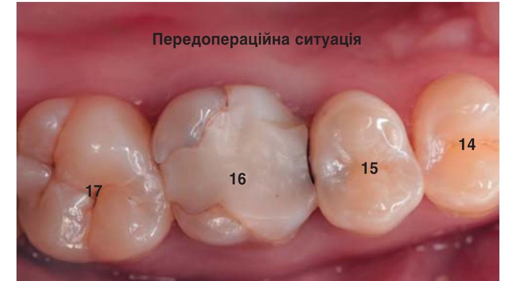 Вигляд зуба 16 на момент огляду.
