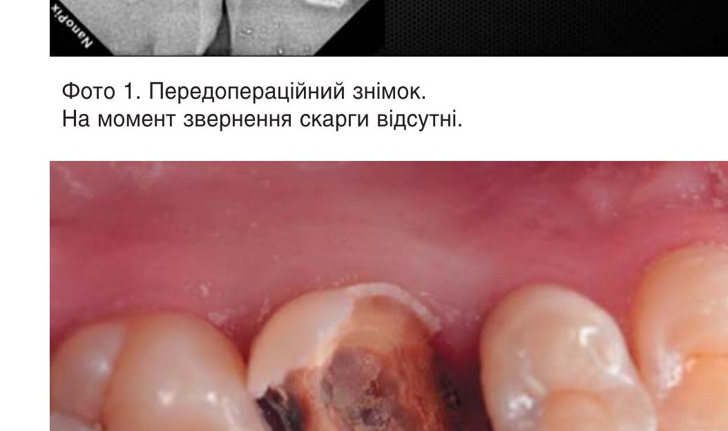 Після видалення композитної пломби.