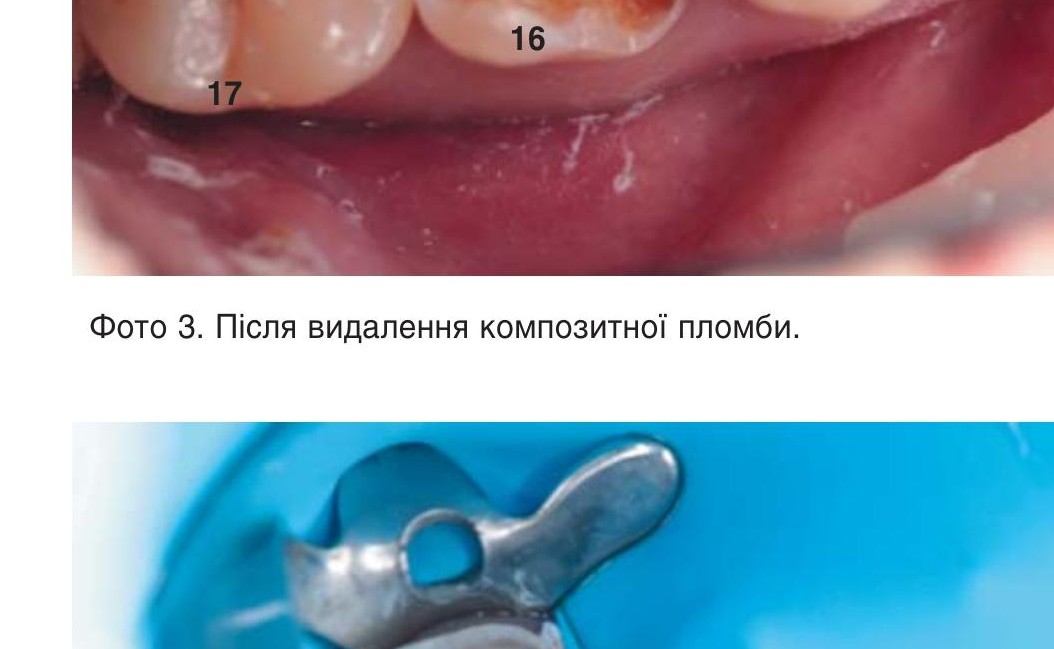 Ізоляція робочого поля.