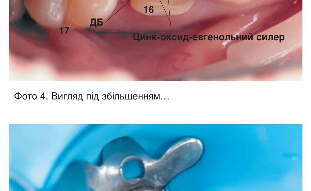 Вигляд після повітряно-абразивної обробки.