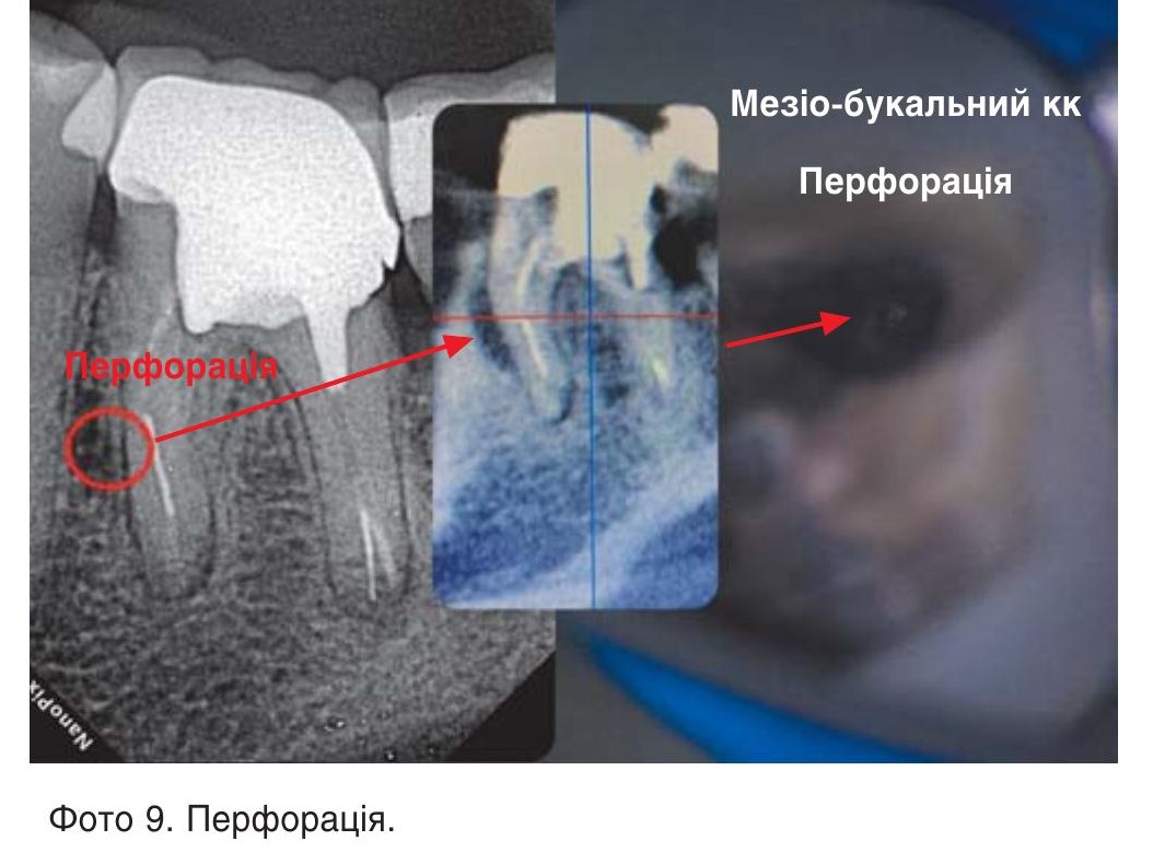 Перфорація.