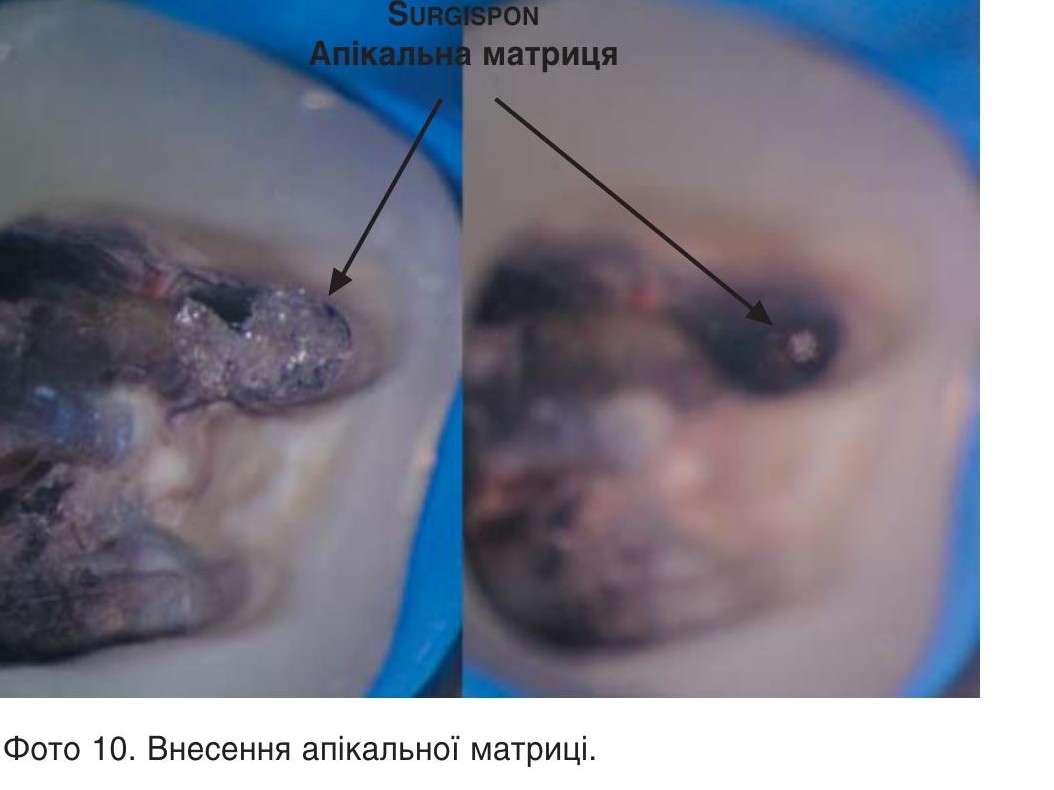 Внесення апікальної матриці.