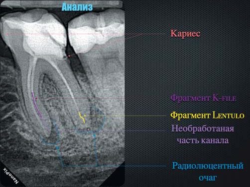 Аналіз передопераційного знімка: карієс, фрагмент K-file, фрагмент Lentulo, радіолюцентний очаг.