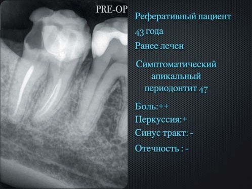 Передопераційний знімок зуба 47 (симптоматичний апікальний періодонтит).