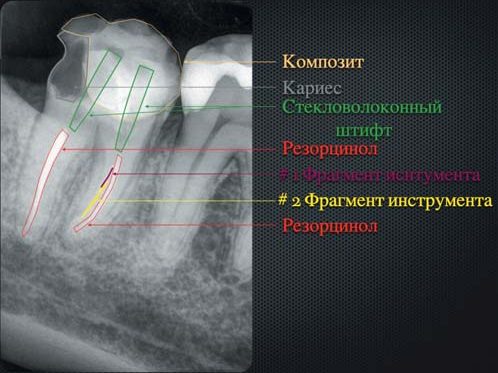 Аналіз передопераційного знімка: композит, карієс, скловолоконний штифт, резорцинол, фрагменти інструмента.