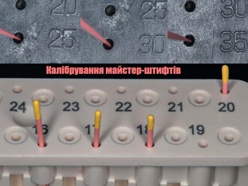 Клінічний випадок 1: проходження МБ2, обтурація кореневих каналів і контроль результату через 2 роки