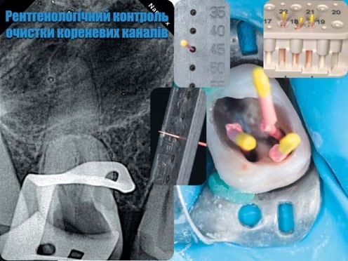 Клінічний випадок 2: обтурація кореневих каналів, апексифікація і фіксація коронки зуба 16