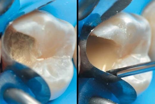 Секційна матриця; Biodentine XP на оголеному пульпарному розі, покритий текучим композитом Vertise Flow.
