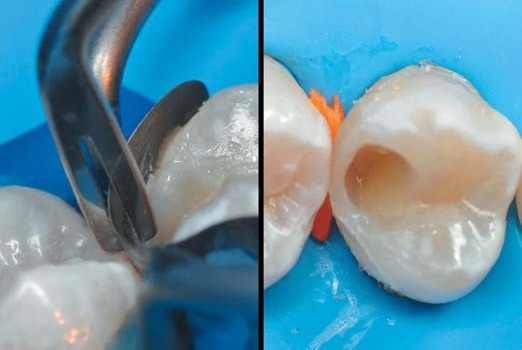 Відновлення проксимальної стінки інструментом LM-Dental Misura Posterior: порожнину Класу II перетворено на порожнину Класу I.
