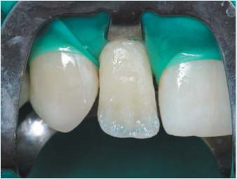 Вестибулярно основний дентин і основна емаль