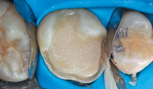 Установка металевих секційних матриць