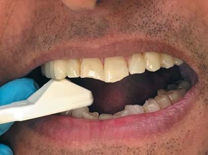 (продовження). Методика застосування Tooth Slooth на бічних зубах.