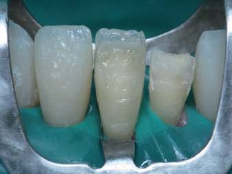 Заміна реставрацій у нижніх зубах