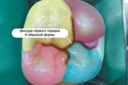 Принципи модульного відновлення зубів