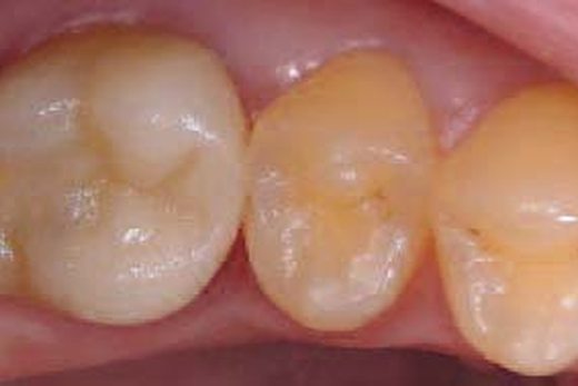 Пряме нанесення Biodentine™ під непрямі керамічні реставрації