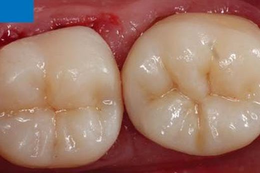 Непрямі накладки CEREC Tessera за одне відвідування