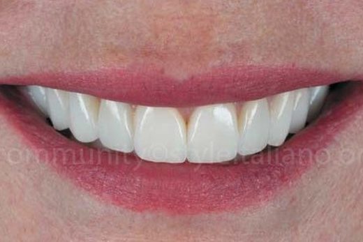 Тимчасові конструкції як запорука успішного естетичного протезування керамічними вінірами