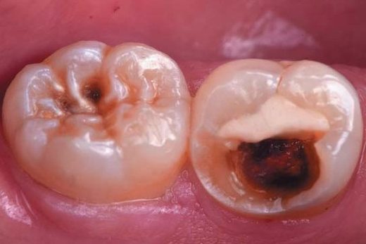 Використання Biodentine для прямих і непрямих реставрацій