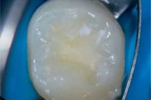 Лікування вітальної пульпи Biodentine при дентальній евагінації