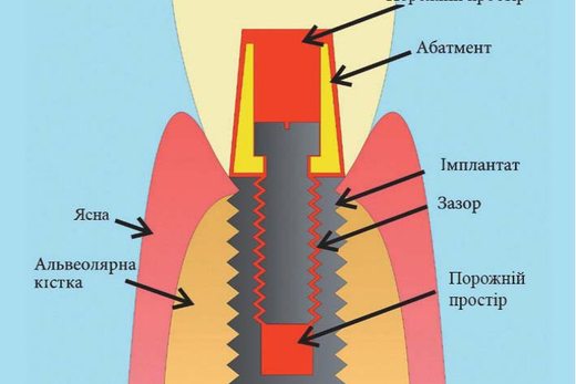Успішна профілактика періімплантиту